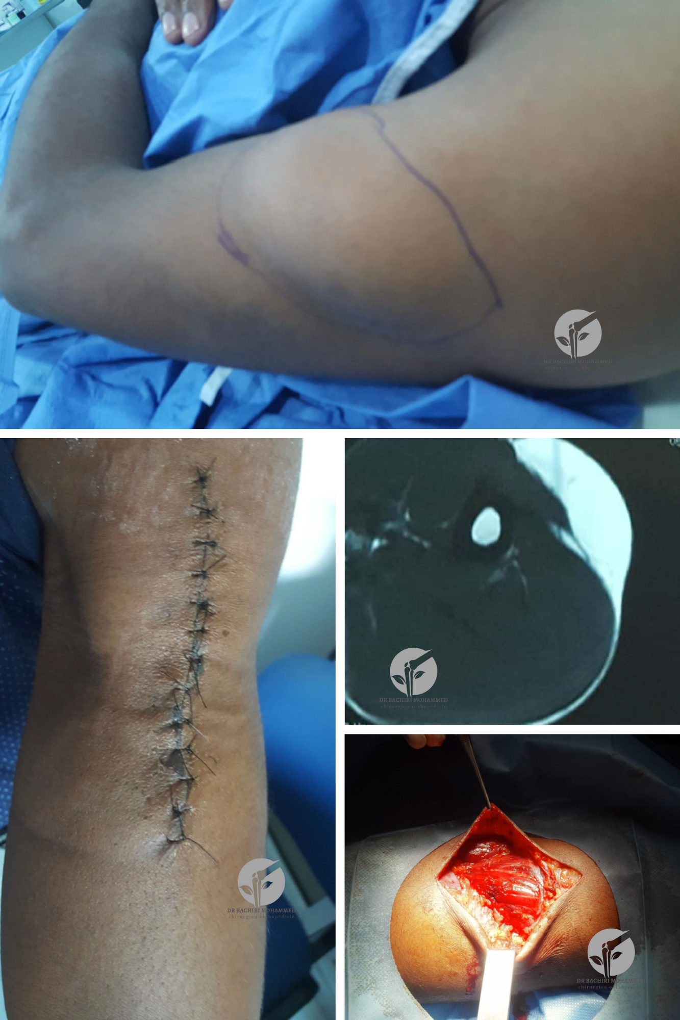 Lipome de l'épaule traité par Dr. Bachiri Mohammed à Oujda